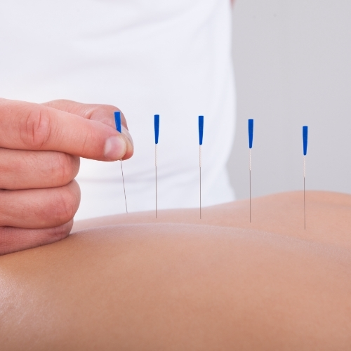 Dry-needling-Kleinpeter-Physical-Therapy-Zachary-Baton-Rouge-LA